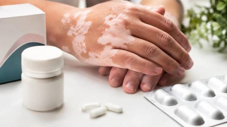 RINVOQ (upadacitinib) گولی اور جلد کی تصویر