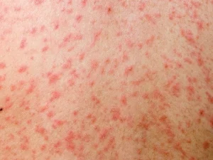 بنگلہ دیش میں خسرے سے کم و بیش ایک ہزار بچے جاں بحق