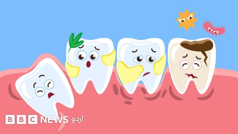 منہ کے پچھلے حصے میں نکلتی ہوئی عقل داڑھ کی نمائندہ تصویر